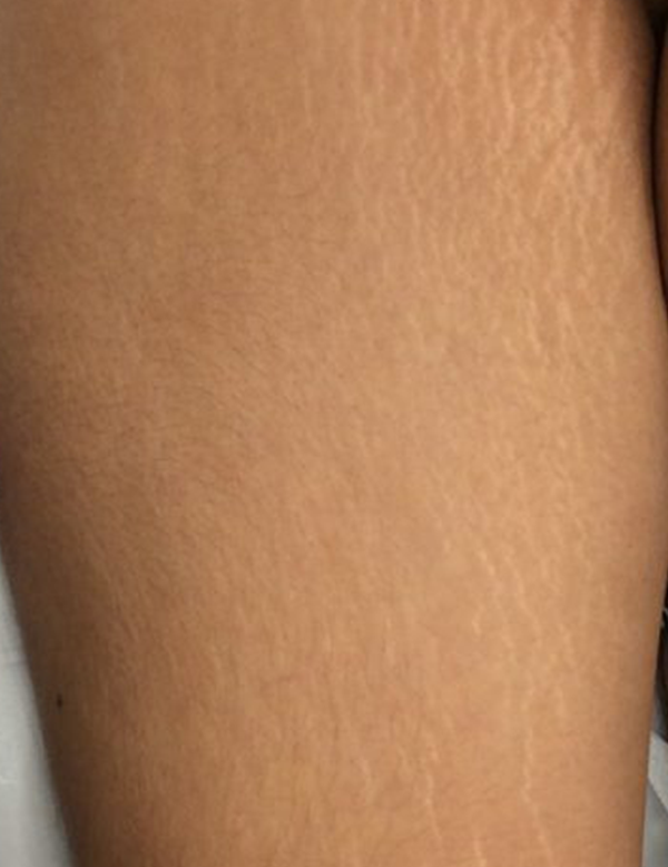 Skin showing visible stretch marks before treatment