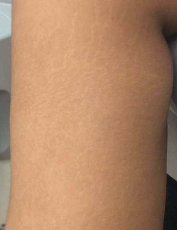 Improved skin with reduced appearance of stretch marks after treatment