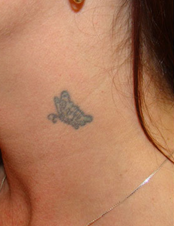 Small neck tattoo visible on skin before removal treatment
