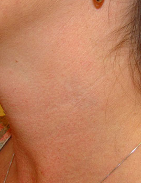 Clear neck skin after tattoo removal