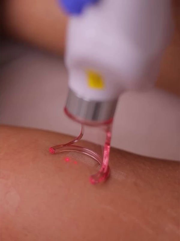 Laser device treating stretch marks on skin to improve texture