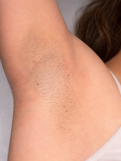 Underarm area with visible hair before treatment