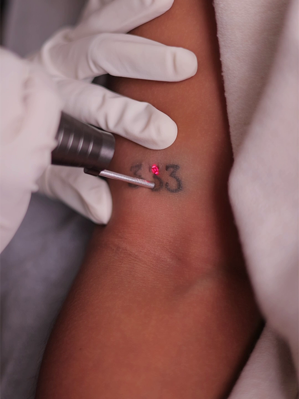 Dermatology procedure targeting tattoo ink on skin