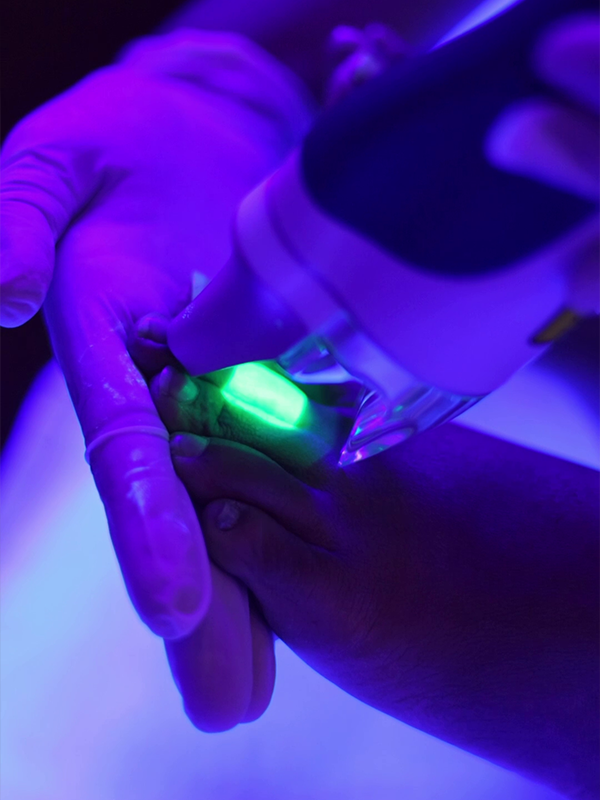 Laser leg hair removal procedure