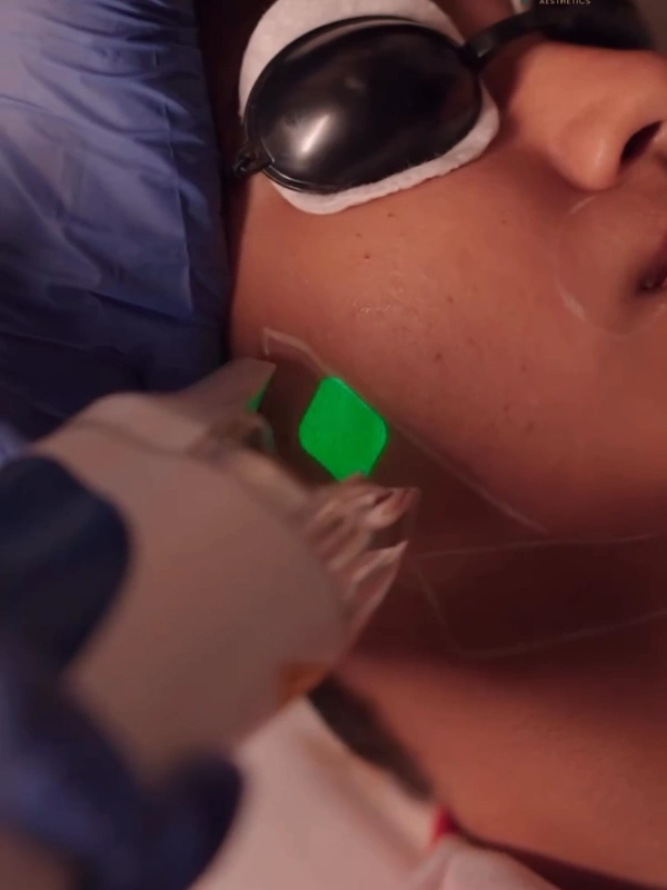 Face laser hair removal procedure