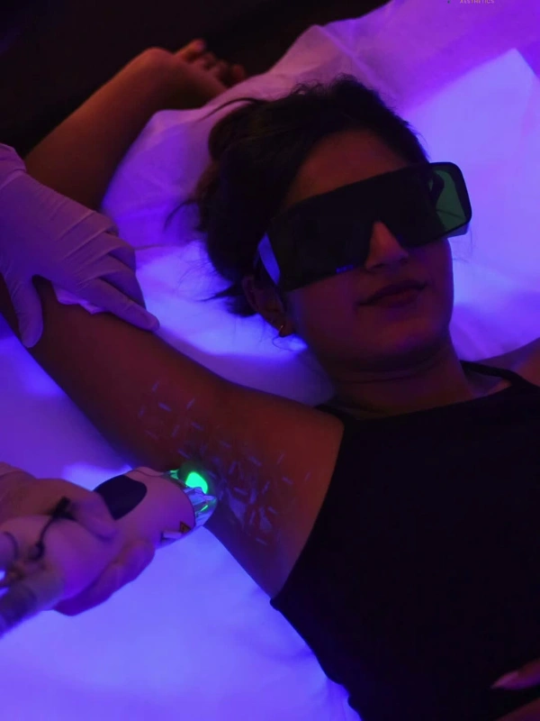 Person undergoing laser hair removal session with protective eyewear
