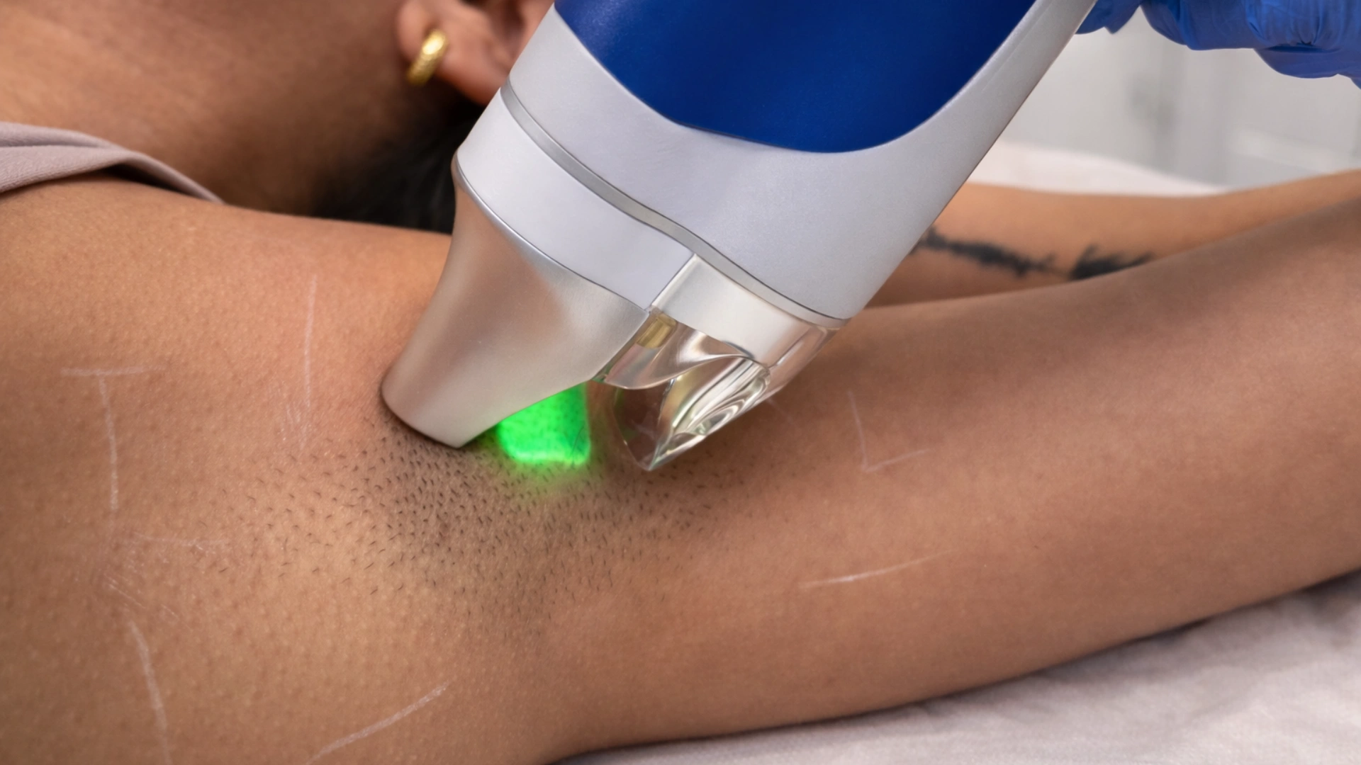 Laser hair removal procedure on underarm area for reducing unwanted hair