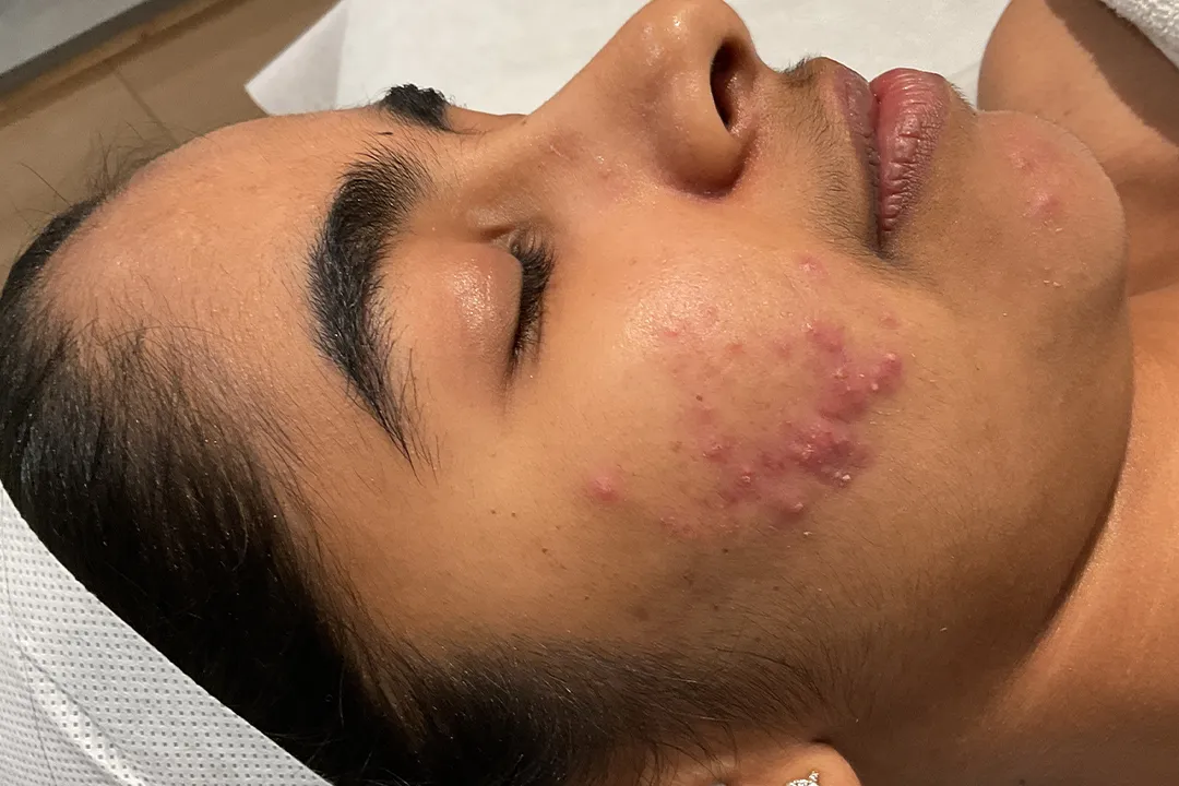 Acne control treatment – clear skin after personalised acne and breakout therapy