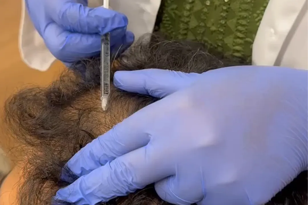 Hair restoration treatment – improved scalp density and hair regrowth after advanced therapy