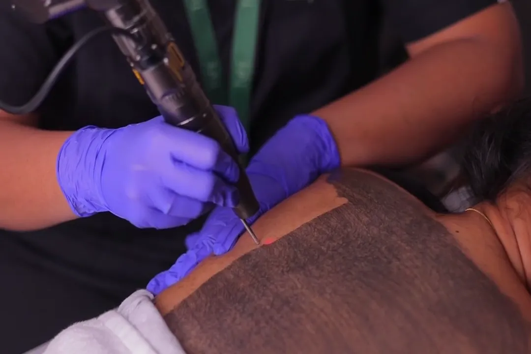 Body contouring treatment – toned and refined body contours after non-invasive procedure