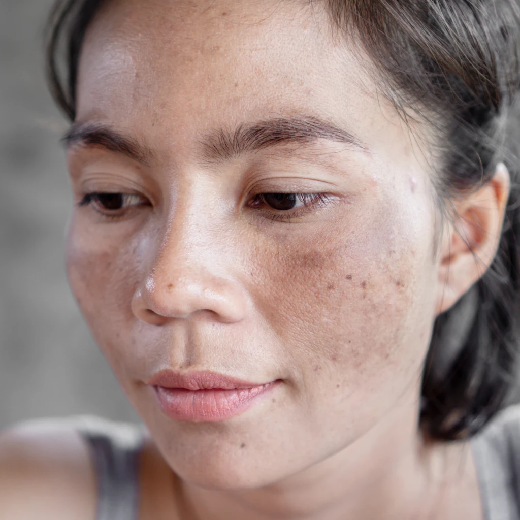 Best Melasma Treatment: Dermatologist-Recommended Solutions