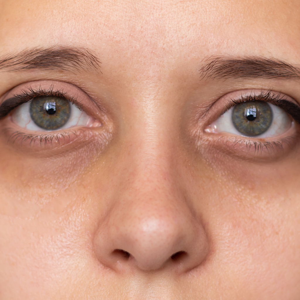 How to Prevent Dark Circles Under Eyes: Effective Tips for a Fresher Look