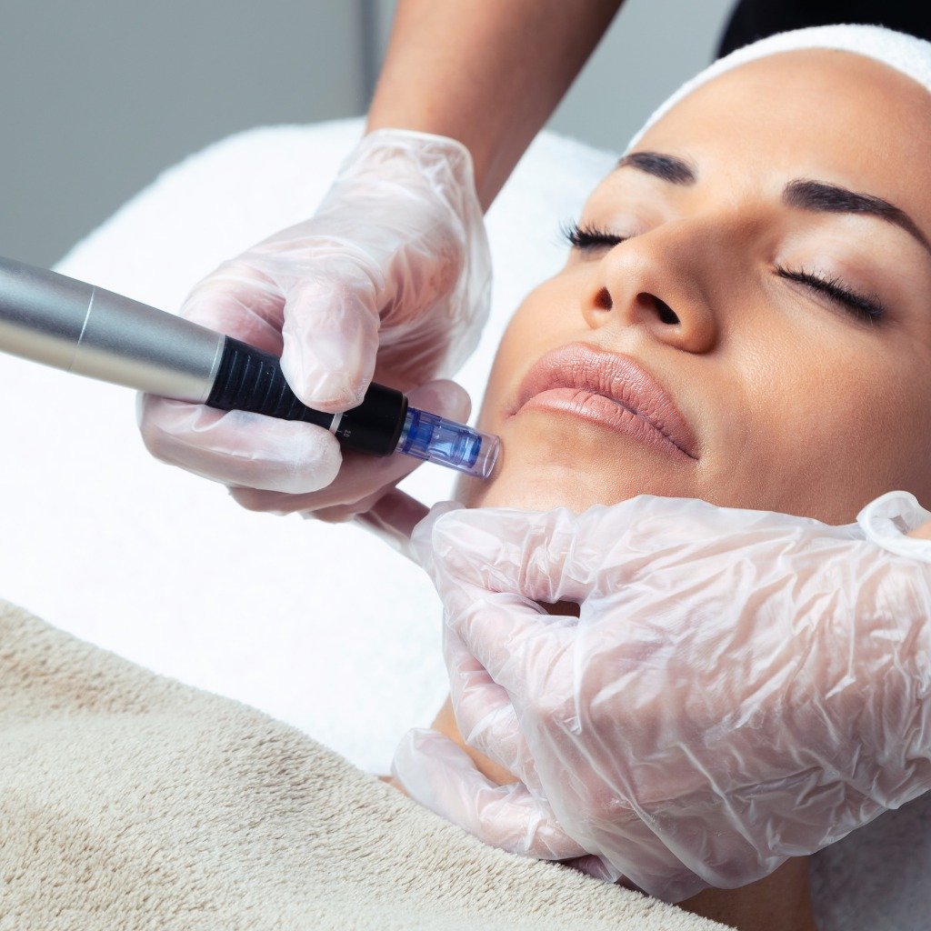 How does microneedling work, and what is its role in dermatology?