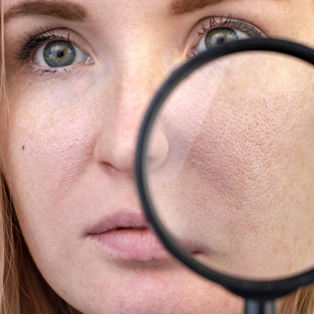 How to Get Rid of Open Pores on Face Permanently
