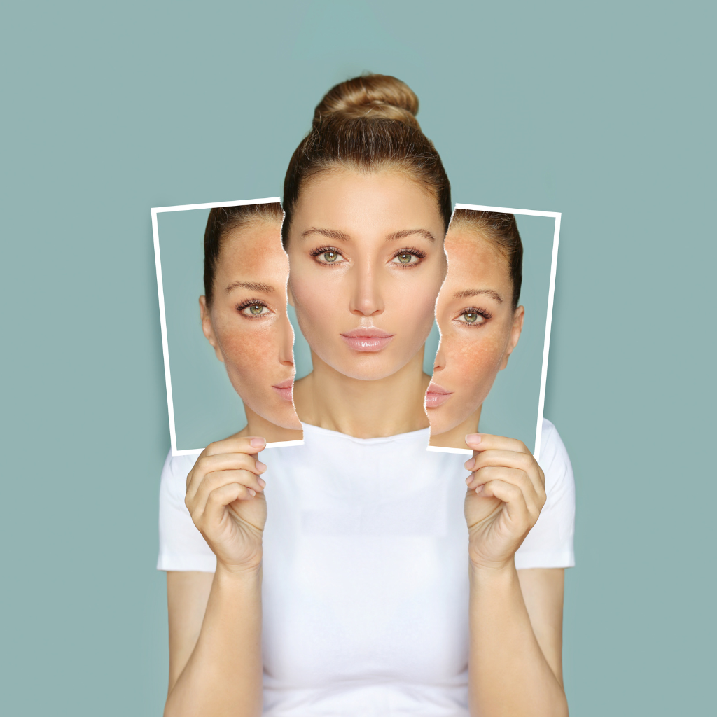 What Is Skin Discoloration? Understanding Causes and Solutions