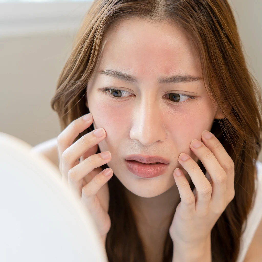 How to Remove Sun Burn Marks on Face: A Helpful Guide