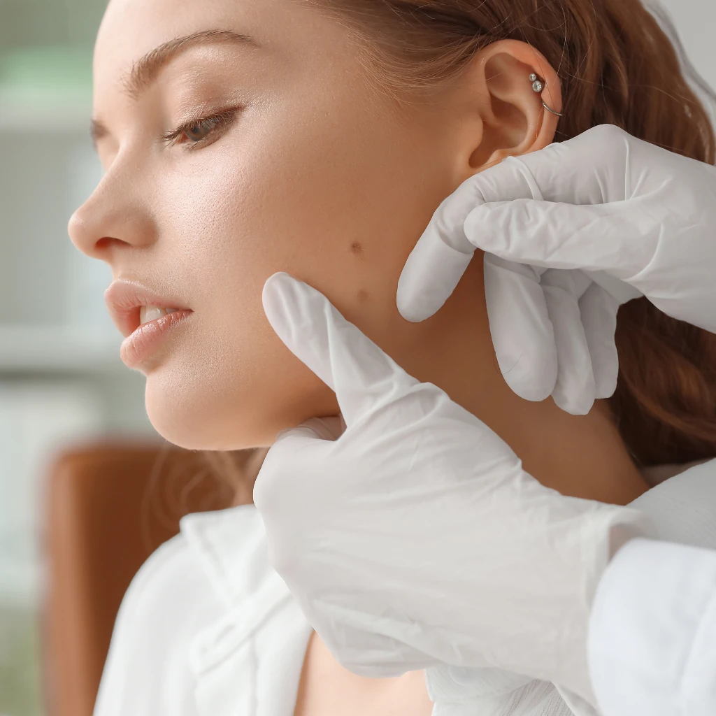 How to Remove Moles from Face: A Simple Guide to Clearer Skin