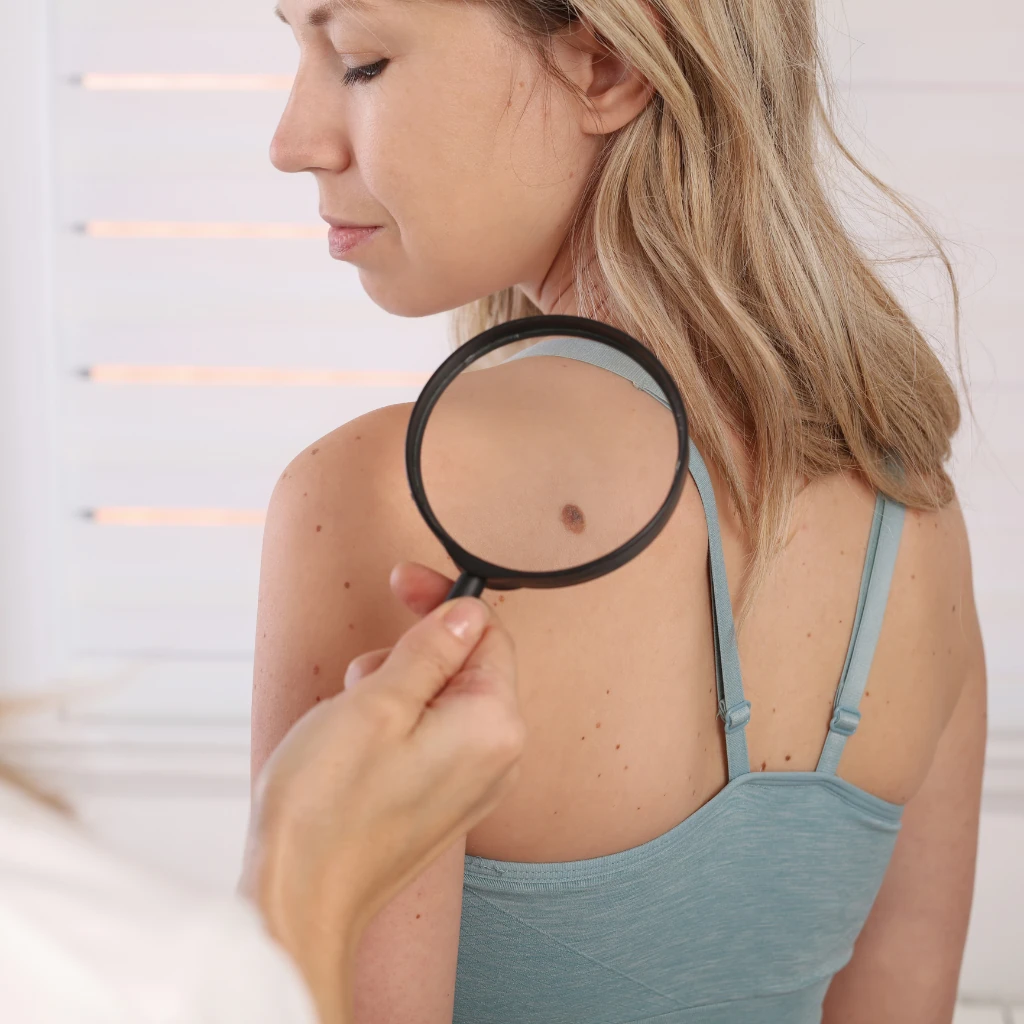 How to remove Skin tags : Effective methods, causes and home remedies