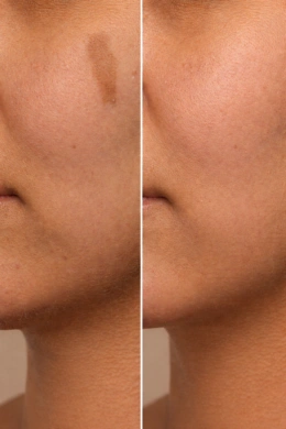 More even skin tone after birthmark treatment