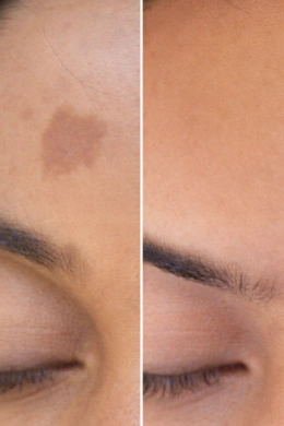 Better skin blending after birthmark treatment