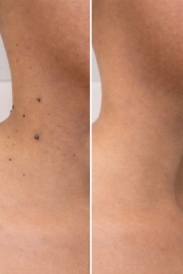 Clean skin tag removal procedure