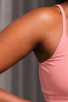 Better skin blending after stretch mark treatment