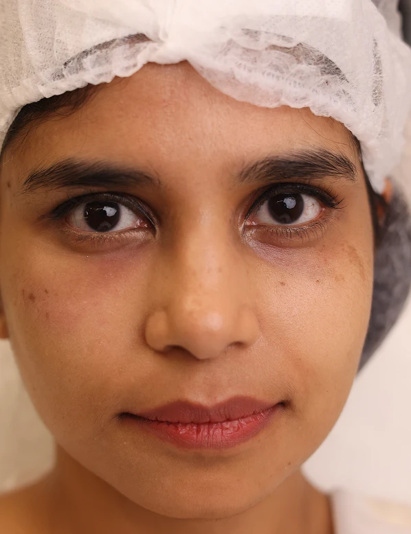 Loose and sagging skin with visible laxity before treatment