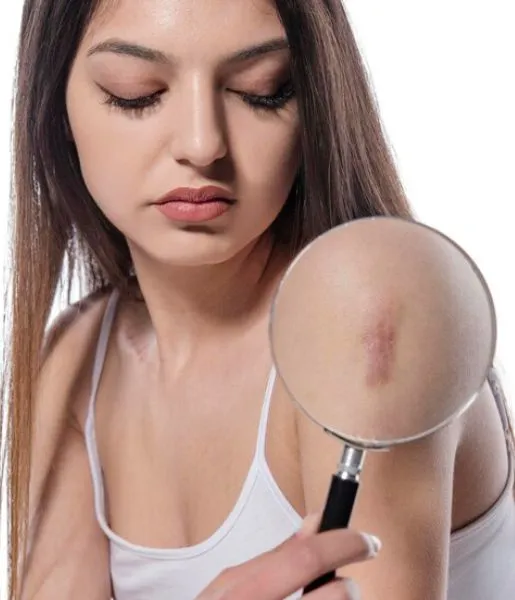 A woman wearing a white dress and showing her arm closely through a magnifying lens has a birthmark.