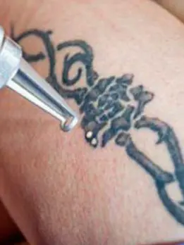 A laser tattoo removal treatment, a person enhances the appearance of their arm by getting a tattoo.