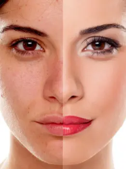 The image explains how skin looks different before and after getting treatment for hyperpigmentation