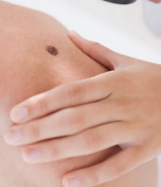 A dermatologist checks the patient's skin and removes moles to improve the look of the patient skin.