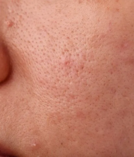 A woman's face, closely showing many severe open pores, displays her skin imperfections and scars.