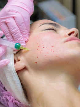 A woman receives a needle facial treatment to improve the appearance of her skin and rejuvenate it