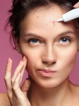 A lady has had enough of her acne & pimples, pinching the area with a white tip to get rid of them.