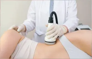 A woman undergoing  stretch marks removal treatment from the best dermatologists skin doctors.