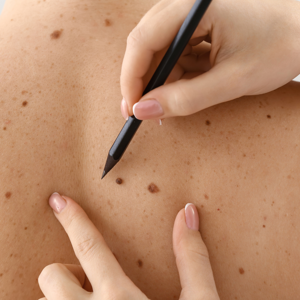 Skin Tags Develop