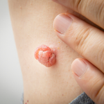 Skin Tag Removal vs Wart Removal: Which Is Right for You?