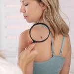 Skin Tag Removal Explained: What Causes Skin Tags and How to Treat Them?