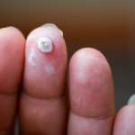 What Is Wart Removal? Effective Remedies to Get Rid of Warts