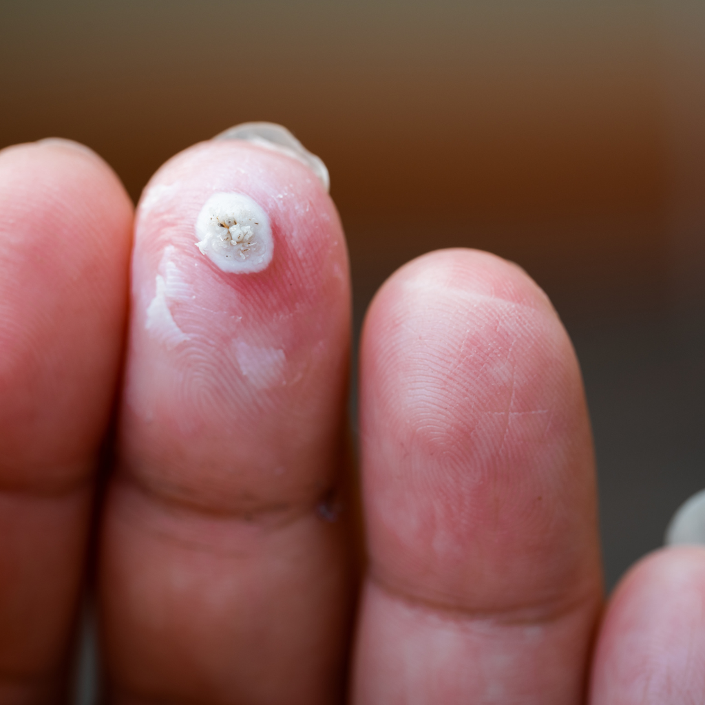 What Is Wart Removal