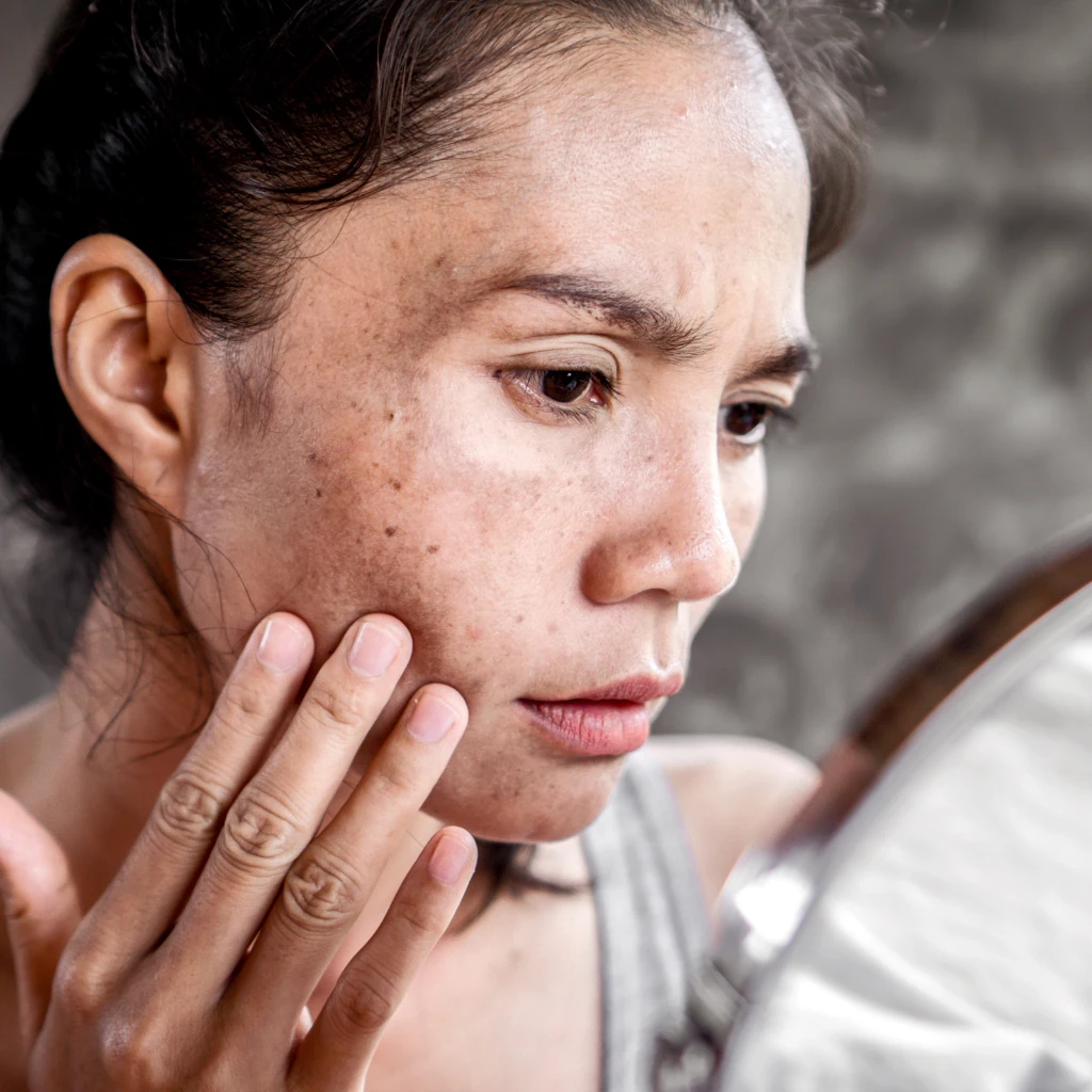 Dullness and Sun Damage