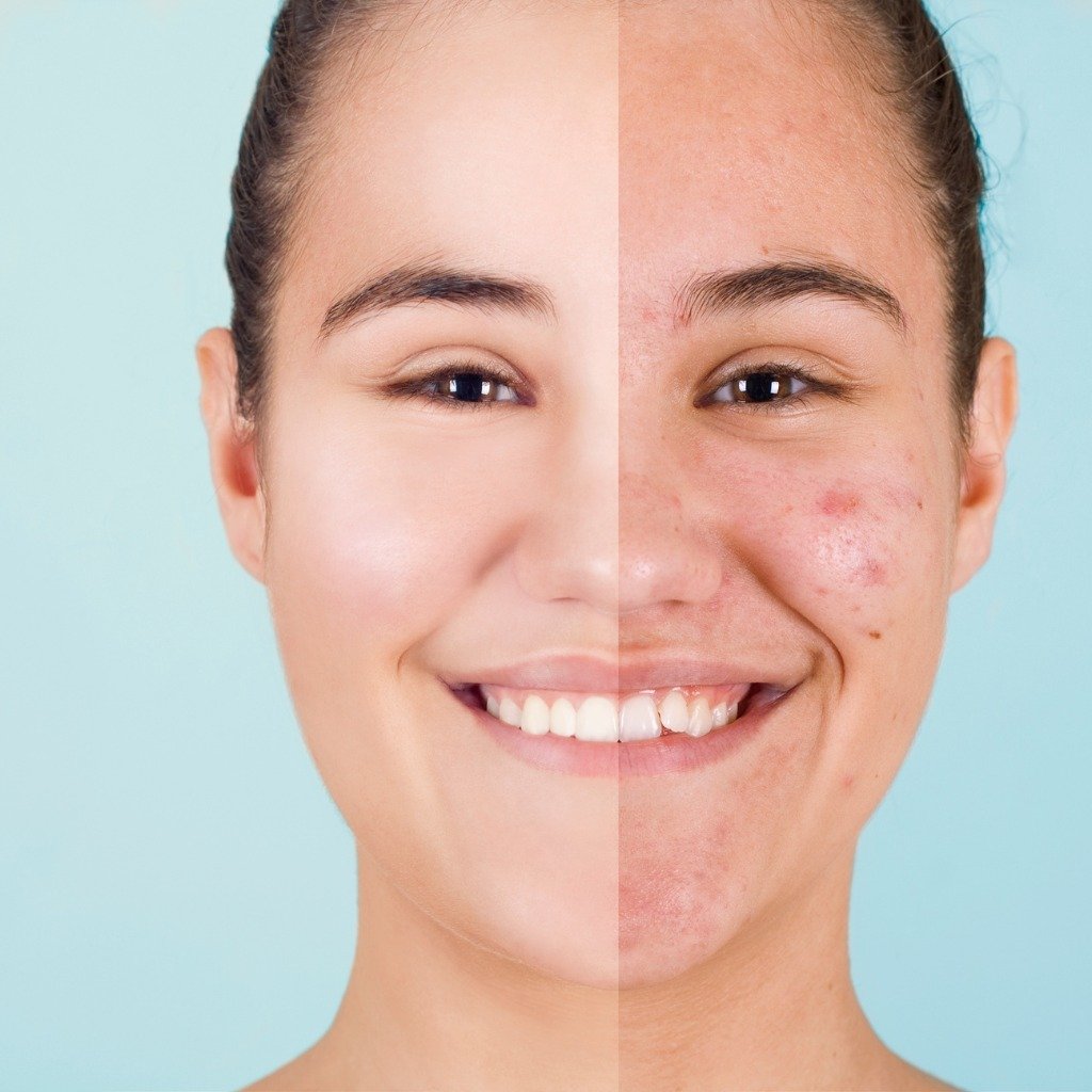 Microneedling for Acne Scars and Stretch Marks