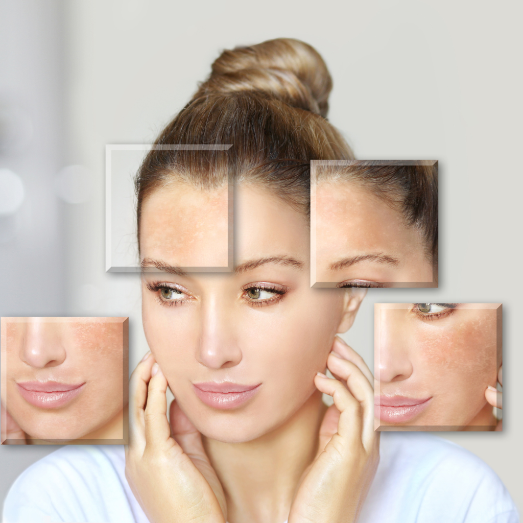 Skin Care is Needed After Skin Lightening