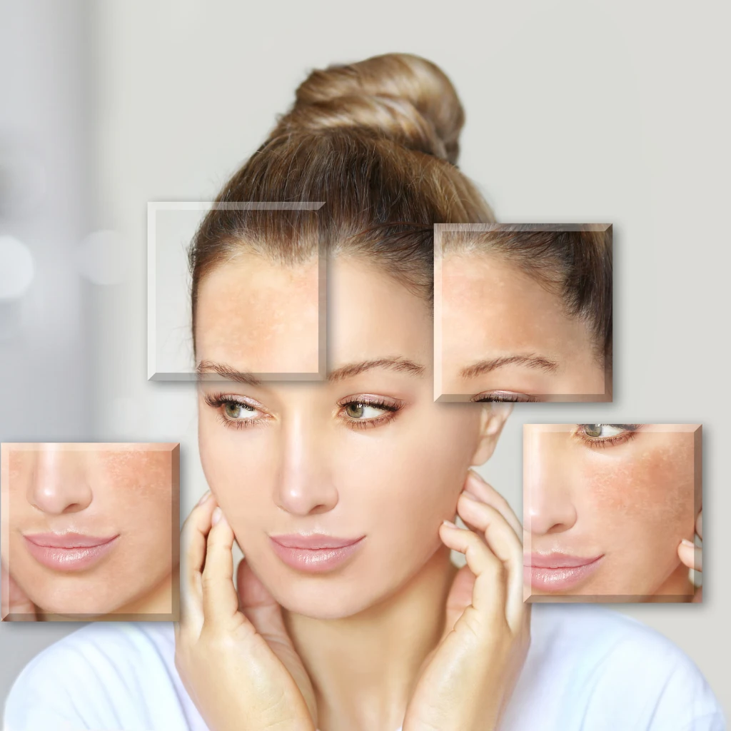 Skin Care is Needed After Skin Lightening