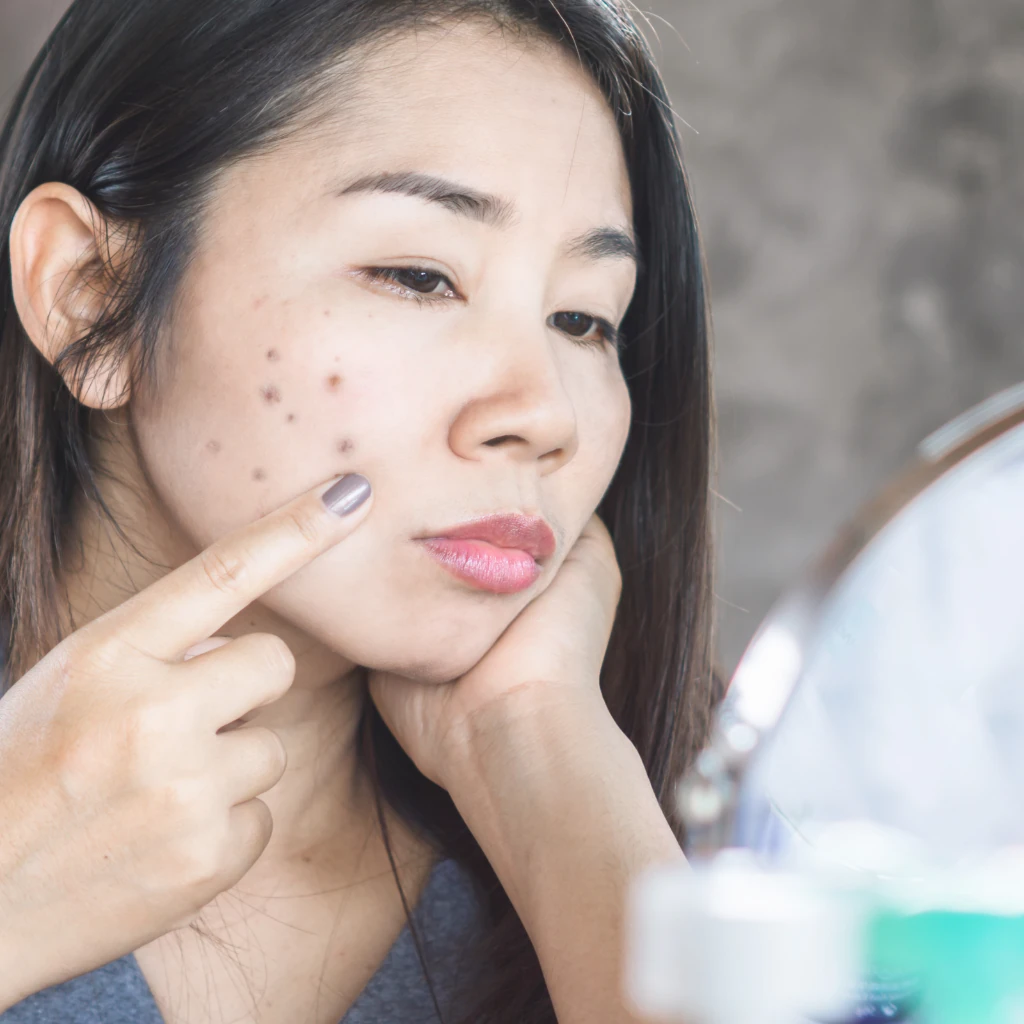 Prevent Future Pimple Marks