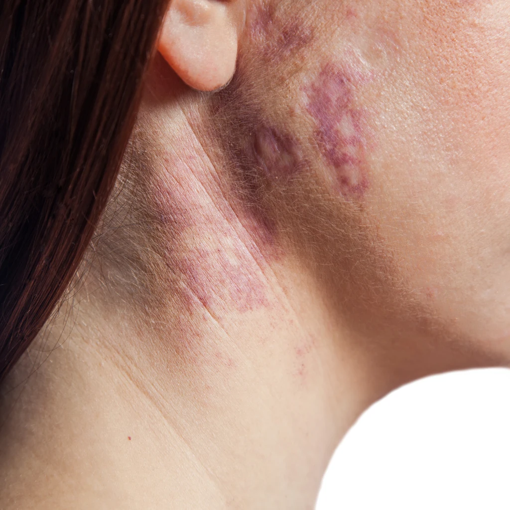 vascular birthmarks