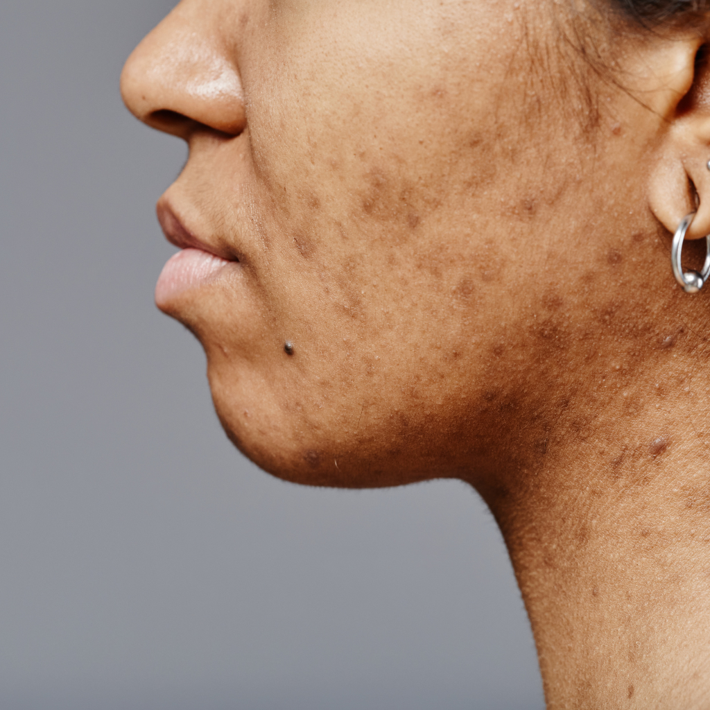 hydrafacial benefits for acne scars