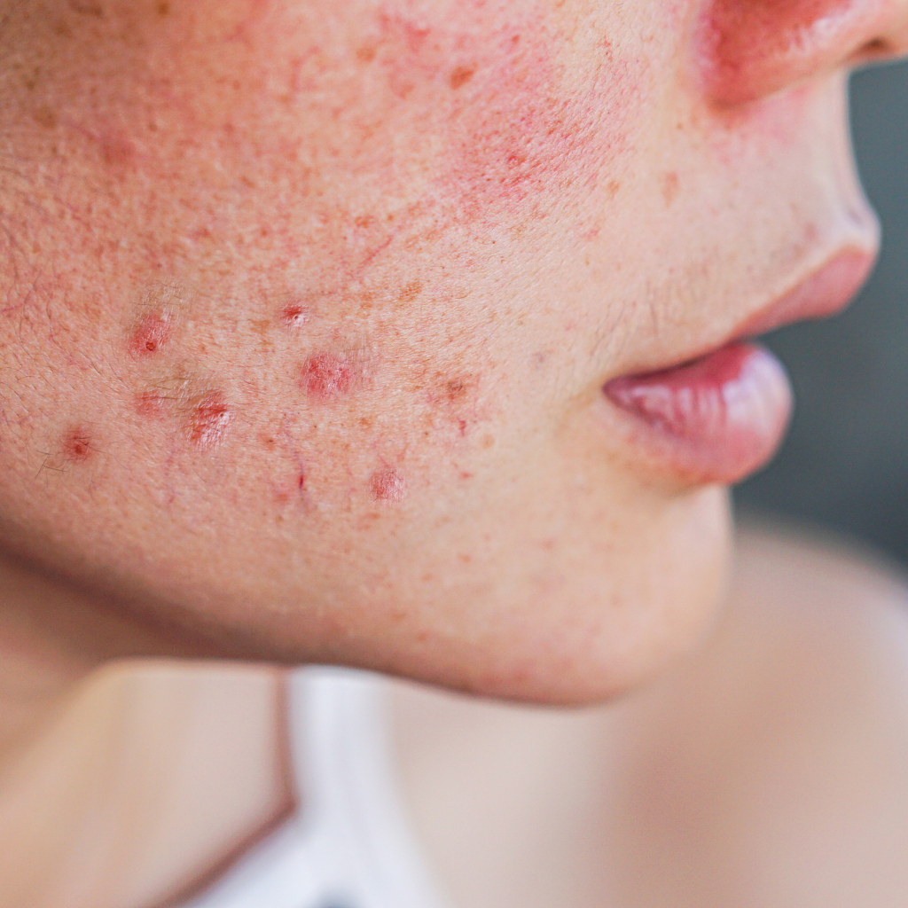 does hydrafacial get rid of blackheads