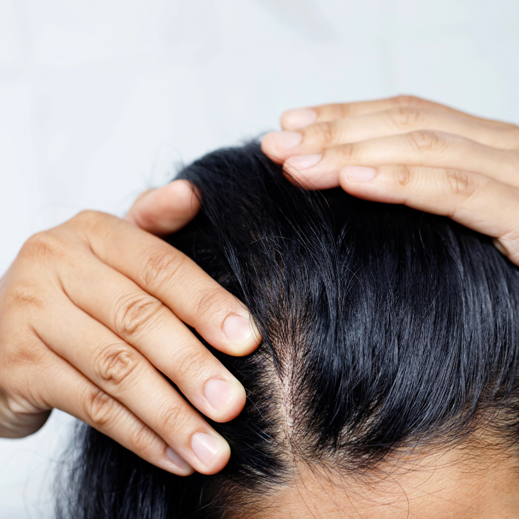 how to decrease hair fall and dandruff