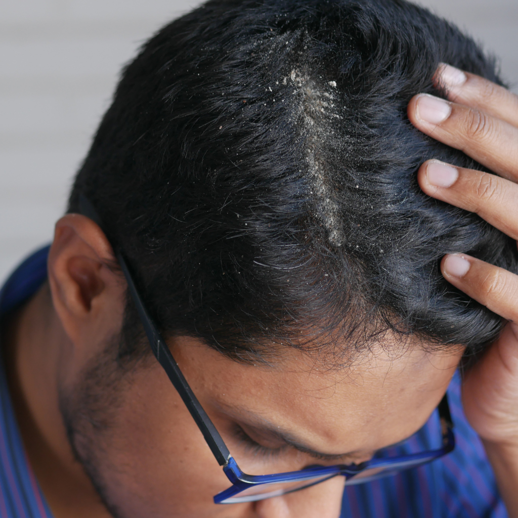 how to prevent hair fall and dandruff
